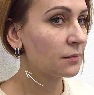 Woman's face after the procedure