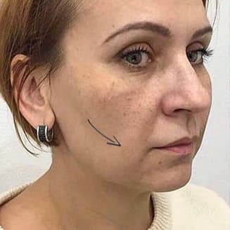 Woman's face before the procedure